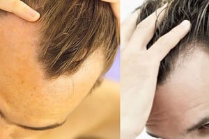 Men’s Grooming – Handling Hair Loss